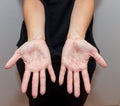 Dyshidrotic eczema skin disease on palms