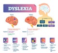 Dyslexia vector illustration. Labeled medical brain illness problem scheme. Royalty Free Stock Photo