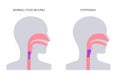 Dysphagia medical poster