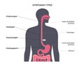 Dysphagia medical poster Royalty Free Stock Photo