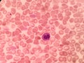 Dysplastic erythroblast. Blood test, red blood cells.