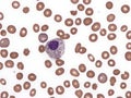 Dysplastic neutrophil.