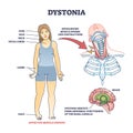 Dystonia disorder as abnormal muscle spasms and contractions outline diagram