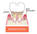 periodontitis tooth and gums. periodontal pocket and bone destruction. Dental and oral care concept.
