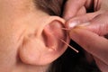 Ear acupuncture