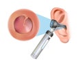 Ear examination with an otoscope. Otitis media with effusion: serous otitis media, secretory otitis media. Iinflammation