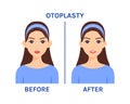 Ear Otoplasty Surgery on a Beautiful Female Face. Before and After. Plastic surgery. Operation. Pretty Ears and a Happy Young