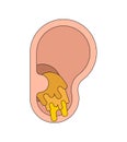 Ear plug Earwax in ear isolated. cerumen vector illustration