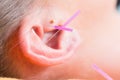 Ear of woman with acupuncture needles