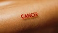 early detection of melanoma and carcinoma can save lives, World Cancer Day February 4th