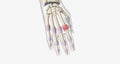 Early Rheumatoid Arthritis in Right 2nd Metacarpophalangeal Joint