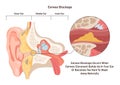 Earwax blockage. Cerumen impaction, medical condition of an middle