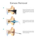Earwax Removal. EARWAX s a common problem which is easily treated.