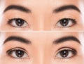 East Asian blepharoplasty or double eyelid surgery