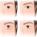 East Asian blepharoplasty, before and after images Royalty Free Stock Photo