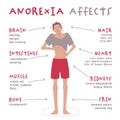 Eating disorder in men and boys. Anorexia nervosa.