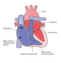 Ebstein`s heart anomaly Royalty Free Stock Photo