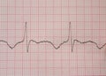 ECG #2