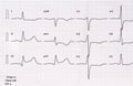 ECG with acute period of large-focal posterior diaphragmatic myocardial infarction