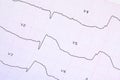 ECG with acute period of large-focal widespread anterior myocardial infarction