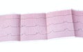 ECG with acute period of macrofocal myocardial infarction, AV block II degree