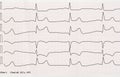 ECG with acute period of macrofocal myocardial infarction