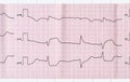 ECG with acute period macrofocal myocardial infarction and vent