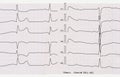 ECG with acute period of macrofocal posterior myocardial infarct