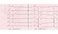 ECG with acute period of myocardial infarction, complete atrioventricular blockade