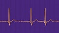 ECG in atrial fibrillation, 3D illustration