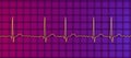 ECG in atrial fibrillation, 3D illustration