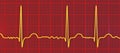 ECG in atrial fibrillation, 3D illustration