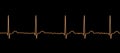 ECG in atrial fibrillation, 3D illustration