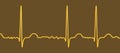 ECG in atrial fibrillation, 3D illustration