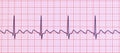 ECG in atrial flutter, 3D illustration