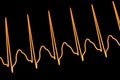 ECG in atrial flutter, 3D illustration