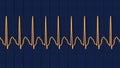 ECG in atrial flutter, 3D illustration