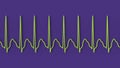 ECG in atrial flutter, 3D illustration