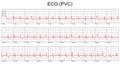 ECG cardiogram.Cardiac Arrhythmia. Premature Ventricular Contraction (PVC). Cardiogram on a white background. Vector Royalty Free Stock Photo