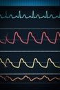 ECG chart on the monitor around the clock surveillance