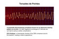 ECG displaying Torsades de pointes rhythm, 3D illustration