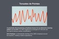 ECG displaying Torsades de pointes rhythm, 3D illustration