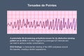 ECG displaying Torsades de pointes rhythm, 3D illustration