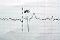 ECG ElectroCardioGraph paper that shows Normal Sinus Rhythm NSR with frequent PACs Premature Atrial Contractions, PVCs Premature Royalty Free Stock Photo