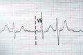 ECG ElectroCardioGraph paper that shows Normal Sinus Rhythm NSR with frequent PACs Premature Atrial Contractions, PVCs Premature Royalty Free Stock Photo