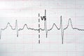 ECG ElectroCardioGraph paper that shows Normal Sinus Rhythm NSR with frequent PACs Premature Atrial Contractions, PVCs Premature Royalty Free Stock Photo