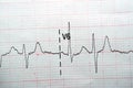 ECG ElectroCardioGraph paper that shows Normal Sinus Rhythm NSR with frequent PACs Premature Atrial Contractions, PVCs Premature