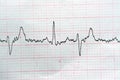 ECG ElectroCardioGraph paper that shows Normal Sinus Rhythm NSR with frequent PACs Premature Atrial Contractions, PVCs Premature Royalty Free Stock Photo