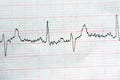 ECG ElectroCardioGraph paper that shows Normal Sinus Rhythm NSR with frequent PACs Premature Atrial Contractions, PVCs Premature Royalty Free Stock Photo