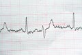 ECG ElectroCardioGraph paper that shows Normal Sinus Rhythm NSR with frequent PACs Premature Atrial Contractions, PVCs Premature Royalty Free Stock Photo